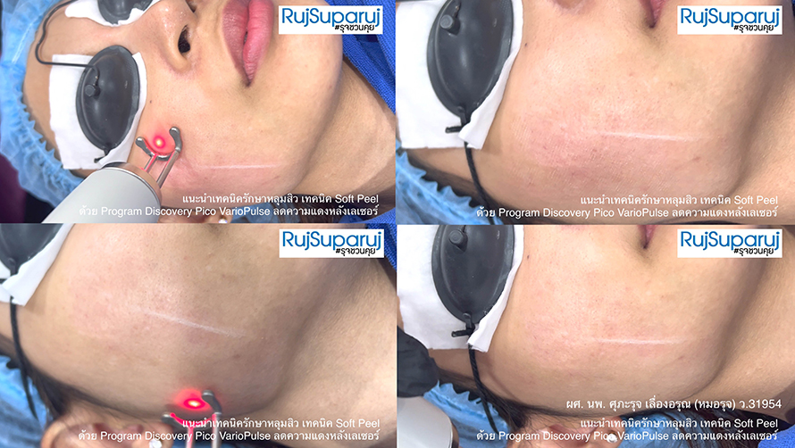 แนะนำเทคนิครักษาหลุมสิว เทคนิค Soft Peel ด้วย Program Discovery Pico VarioPulse ลดความแดงหลังเลเซอร์